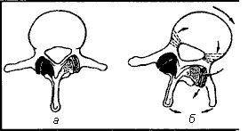 Схема развития деформации поясничного позвонка при сколиозе (по И.А. Мовшовичу)
а - вследствие физиологического лордоза в поясничном отделе при боковом наклоне основная нагрузка приходится на суставные отростки вогнутой стороны (слева); б - в силу второго элемента торсии и действия мышц рост тела позвонка происходит в выпуклую сторону.
